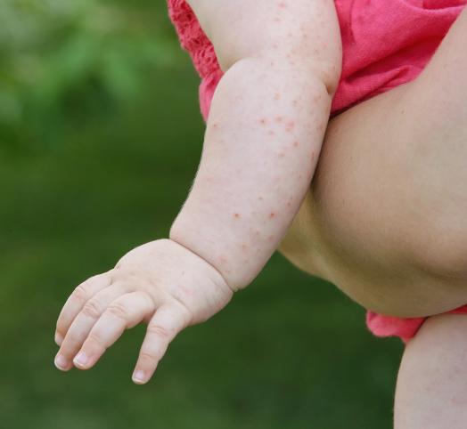 Gros plan sur un bras d'enfant qui a des points rouges sur la peau